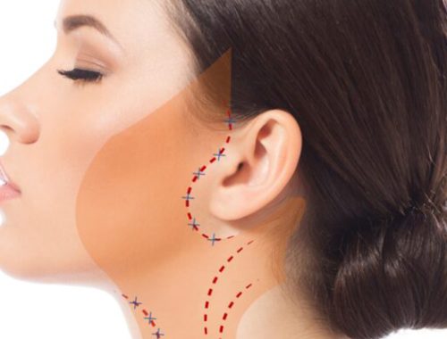 căng da nửa mặt có được khong