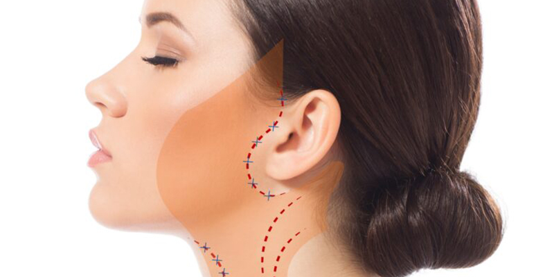 căng da nửa mặt có được khong