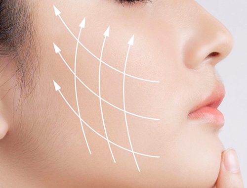 căng da mặt có gây mê không