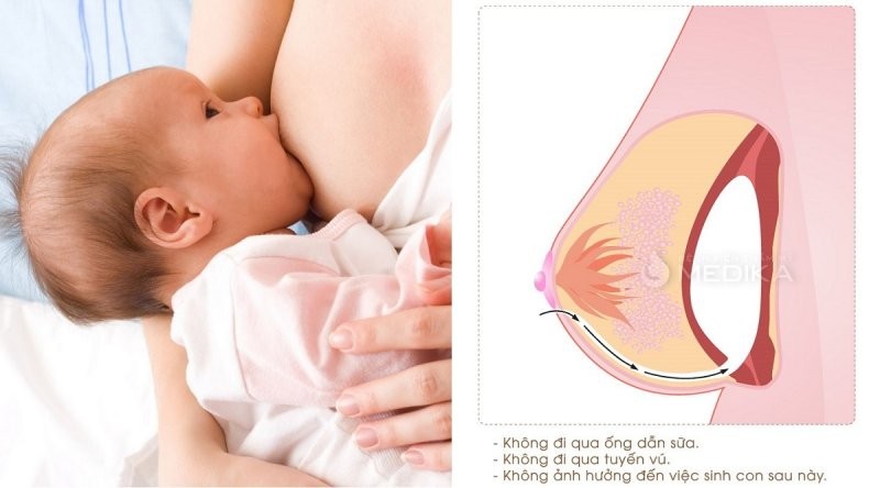 nâng ngực có cho con bú được không