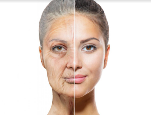 căng da nửa mặt có được không