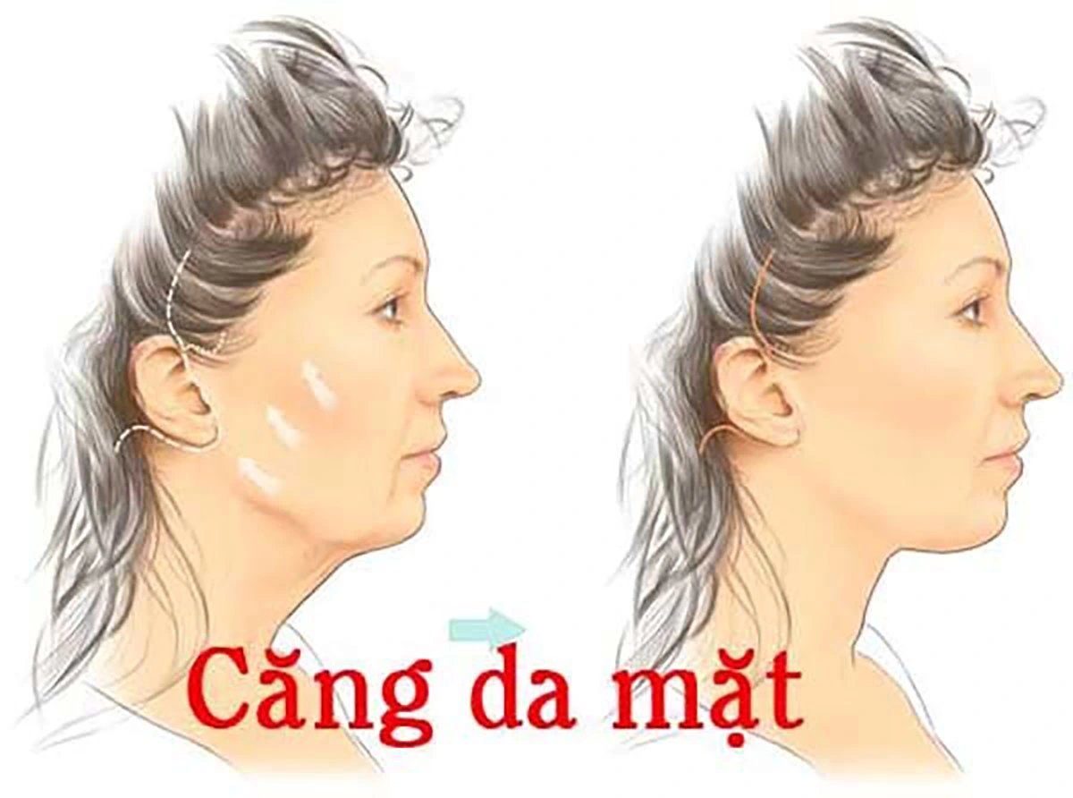 căng da mặt có sẹo không