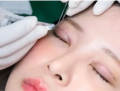 bấm mí mắt