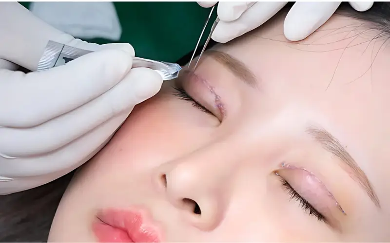 bấm mí mắt