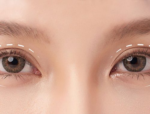 bấm mí mắt bị trơn