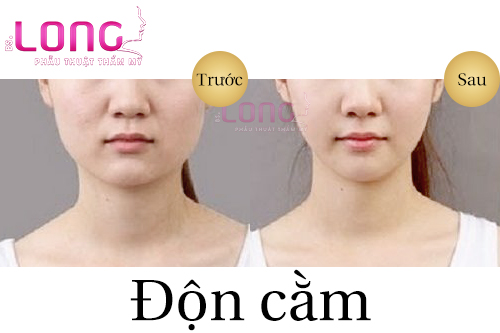 tim-hieu-xem-don-cam-khong-phau-thuat-co-an-toan-khong-1