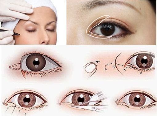 Tuân thủ quy trình chăm sóc sau phẫu thuật để đôi mắt được phục hồi nhanh hơn