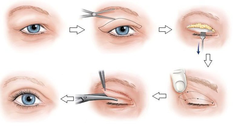 Quy trình cắt da thừa ở mí mắt chuyên nghiệp tại phòng khám uy tín