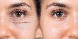 cắt mí có hết nhăn đuôi mắt không