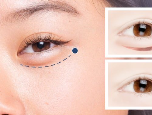 lấy bọng mỡ mí dưới