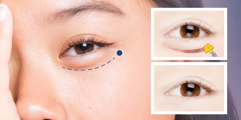 lấy bọng mỡ mí dưới