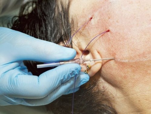 căng da mặt bằng chỉ giữ được bao lâu