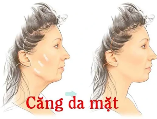 căng da mặt có sẹo không