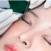 bấm mí mắt